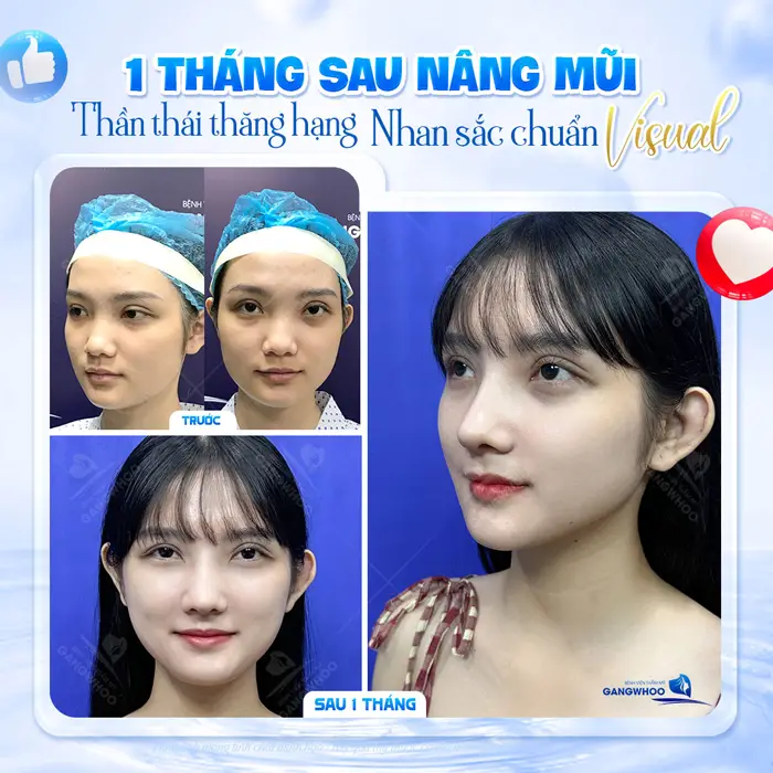 Nâng Mũi Không Phẫu Thuật Có An Toàn Không? Bác Sĩ Giải Đáp