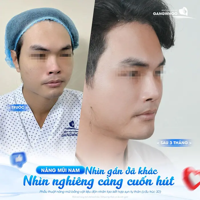 Nâng mũi nam nhìn đã thấy khác nhìn nghiêng càng cuốn hút và đẹp chuẩn sau 3 tháng thực hiện 