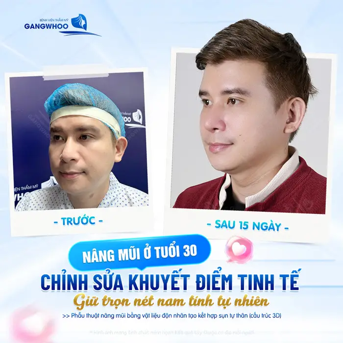 Nâng mũi ở tuổi 30 chỉnh sửa khuyết điểm tinh tế giữ trọn nét nam tính tự nhiên sau 15 ngày đã khác