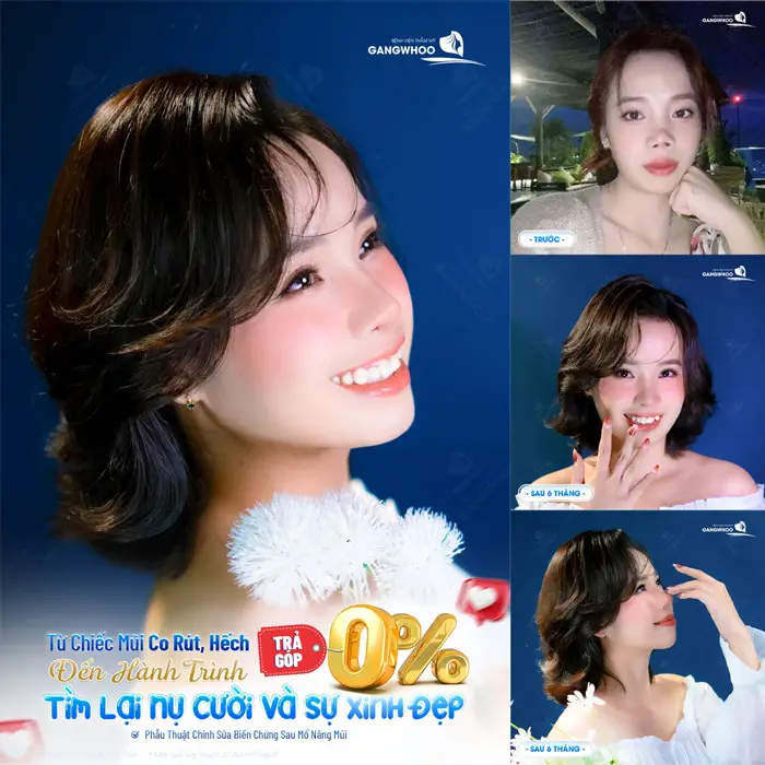 Dịch vụ thẩm mỹ trả góp có tốt không? 1 Từ chiếc mũi co rút và hếch đến tìm lại nụ cười và sự xinh đẹp với mà không lo áp lực chi phí