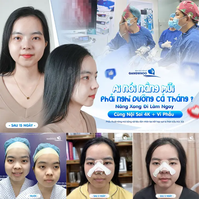Nâng mũi công nghệ nội soi và vi phẫu mũi nhanh lành và nhanh hồi phục