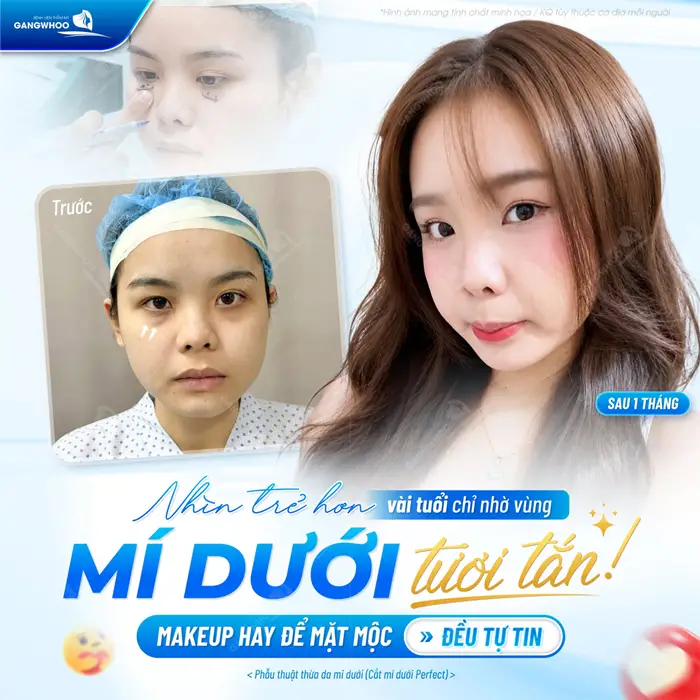Nhìn trẻ hơn vài tuổi nhờ vùng mí dưới tươi tắn và rạng rỡ