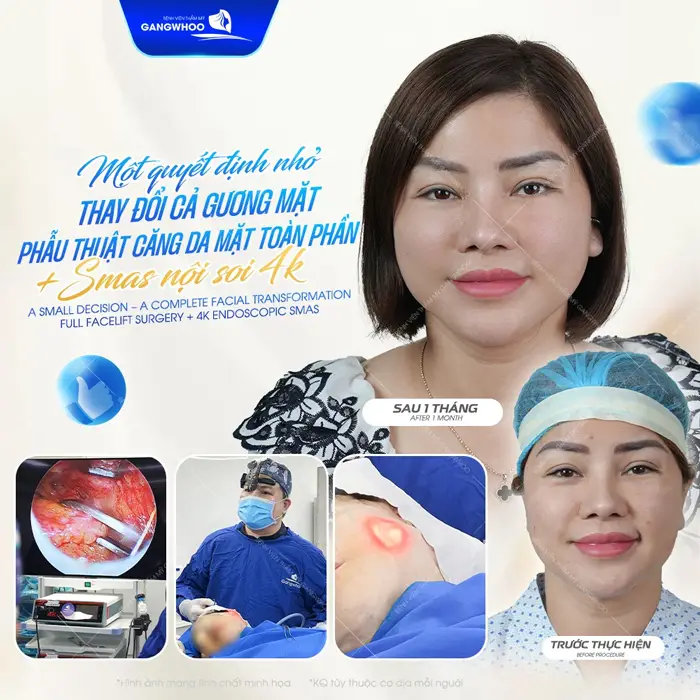 Một quyết định nhỏ thay đổi cả gương mặt sau phẫu thuật căng da mặt Smas nội soi 4K hiện đại 