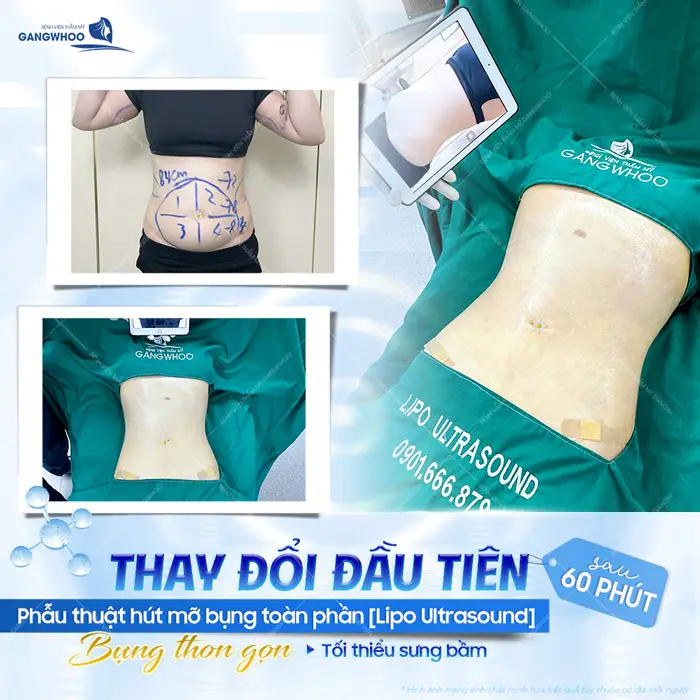 Sau 60 phút phẫu thuật mỡ bụng được cải thiện hoàn toàn giảm thiểu sưng bầm một cách đáng kể