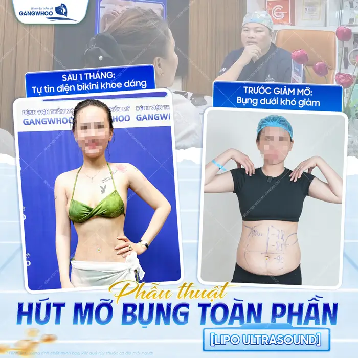Sau 60 phút phẫu thuật mỡ bụng được cải thiện hoàn toàn giảm thiểu sưng bầm một cách đáng kể