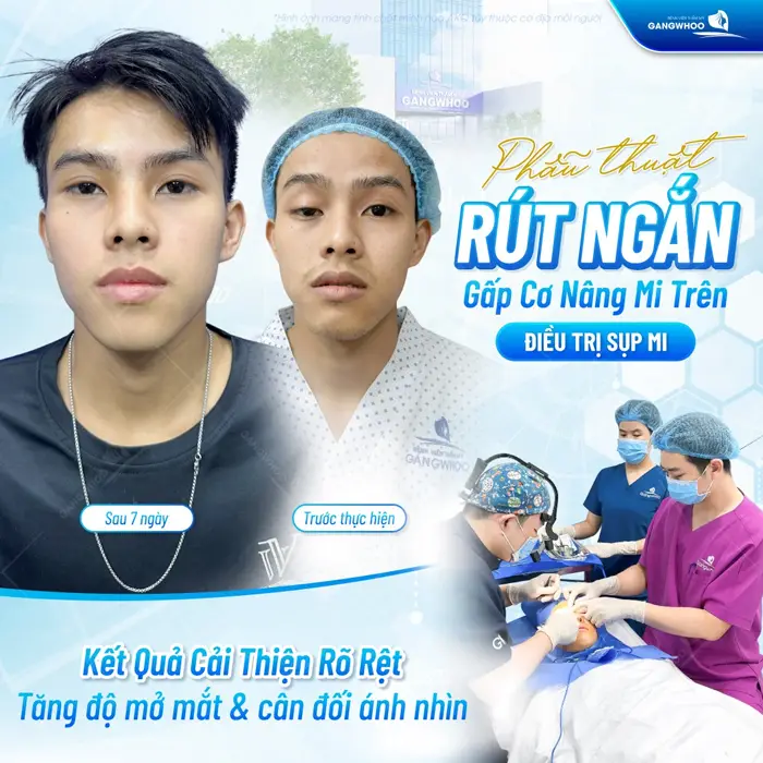 Phẫu thuật rút ngắn gấp cơ mi trên điều trị sụp mi hiệu quả giúp ánh nhìn mở rộng và cân đối hơn