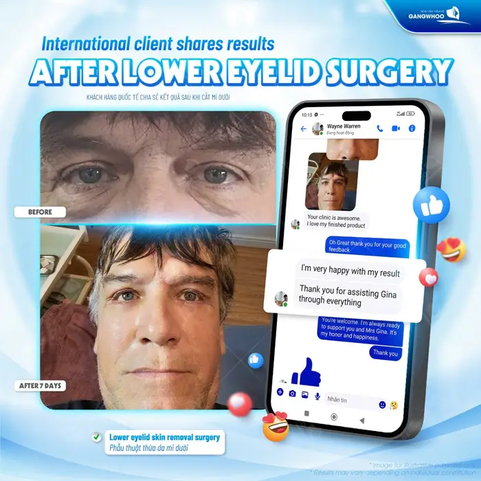Phẫu thuật thừa da mi dưới khách hàng quốc tế bày tỏ sự hài lòng với kết quả 