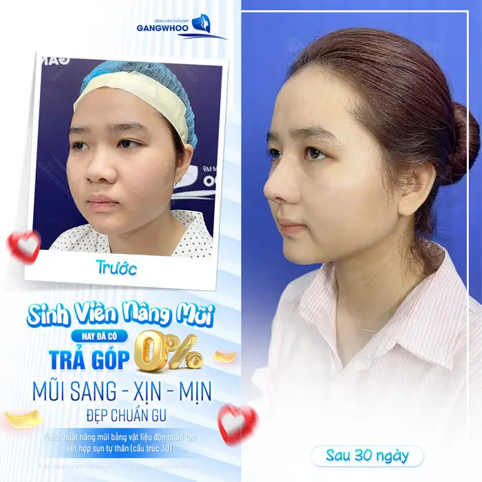 Dịch vụ thẩm mỹ trả góp có tốt không? 4 Sinh viên nang mũi nay đã có trả góp mũi sang, đẹp xịn và cao đẹp chuẩn gu không cần lo về áp lực chi phí