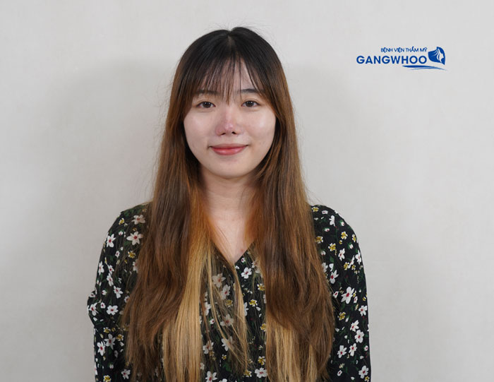 Giang Thi's 4th re-examination after nose revision at Gangwhoo Cosmetic Hospital