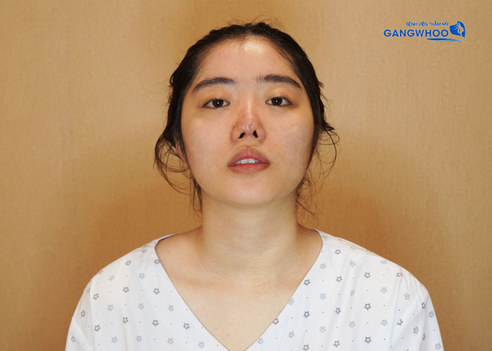 The severely deformed nose of Giang Thi