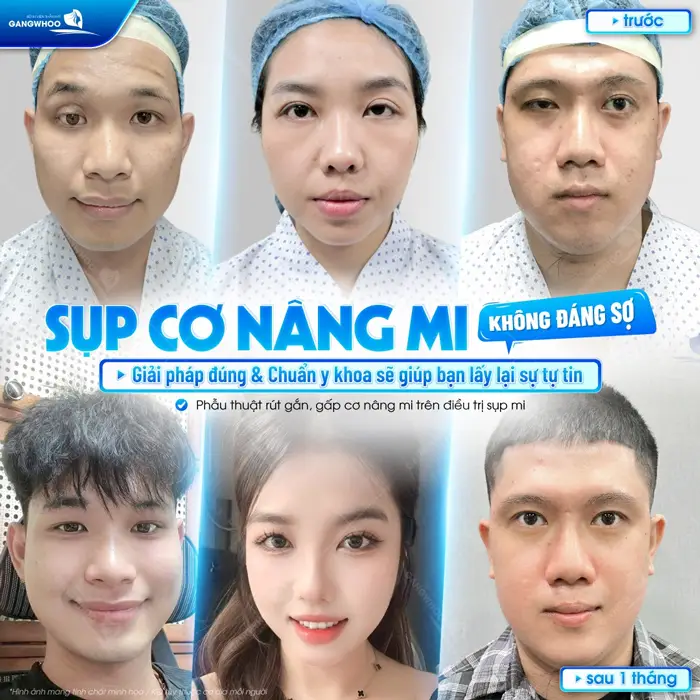 Phẫu Thuật Rút Ngắn, Gấp Cơ Nâng Mi Trên Điều Trị Sụp Mí Bẩm Sinh