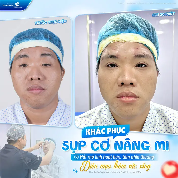 Khắc phục sụp cơ nâng mi mở mắt linh hoạt, tầm nhìn thoáng hơn diện mạo thêm sức sống 