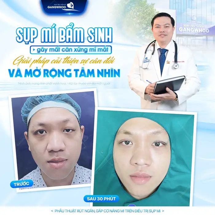 Sụp mí bẩm sinh mí mất cân đối sau phẫu thuật chỉnh lại tại BVTM Gangwhoo mở rộng tầm nhìn, cải thiện đôi mắt