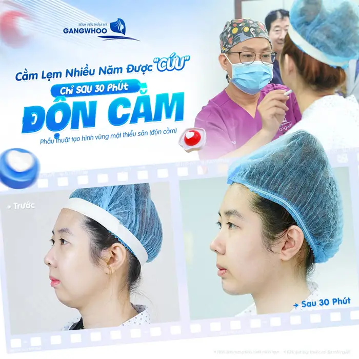 Chỉ sau 30 phút độk cằm tạm biệt chiếc "cằm lẹm" sau nhiều năm đồng hành