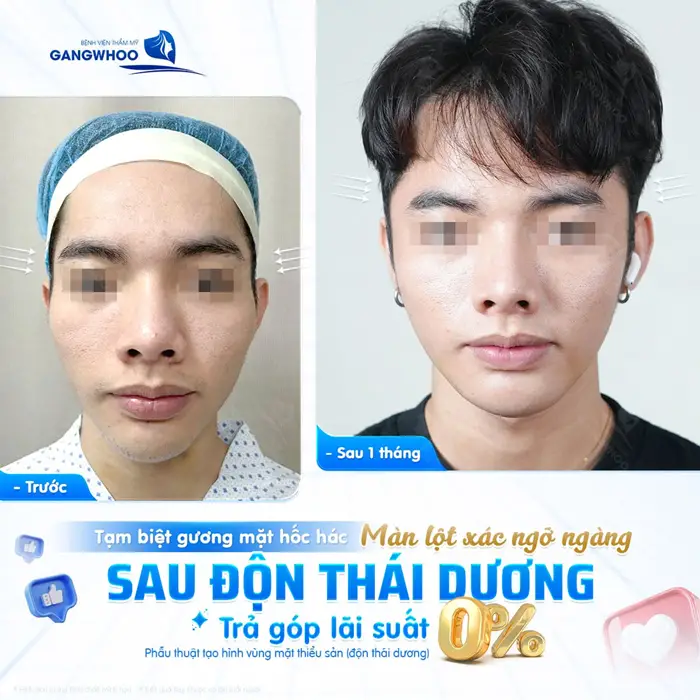Độn Thái Dương Trả Góp Nên Hay Không? Địa Chỉ Nào Uy Tín? 1 Tạm biệt gương mặt hốc hác với màn lột xác sau độn thái dương trả góp lãi suất 0%