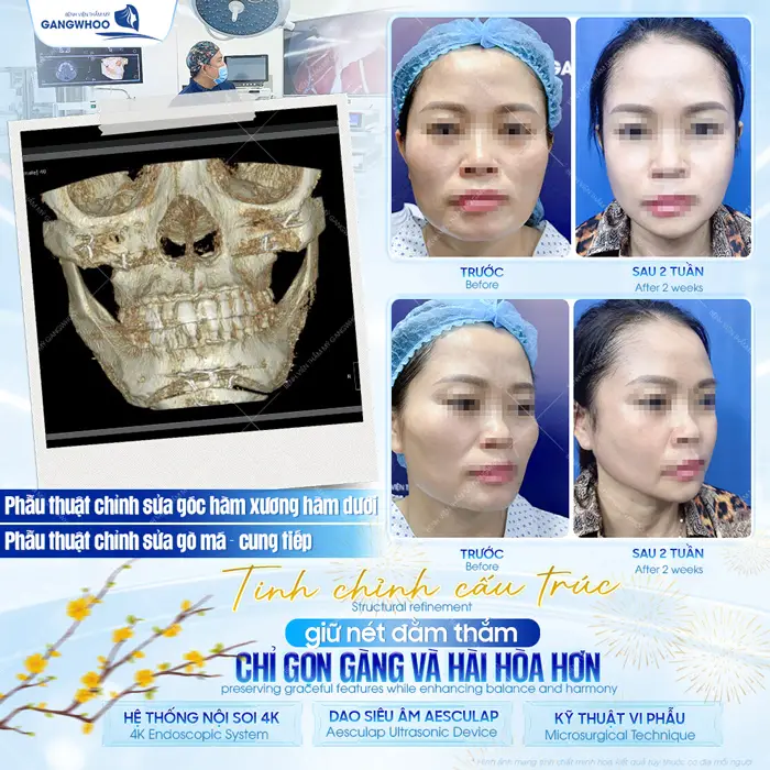 Tinh chỉnh cấu trúc viền cằm giữ nét đằm thắm cho diện mạo khuôn mặt thêm hài hòa và cuốn hút