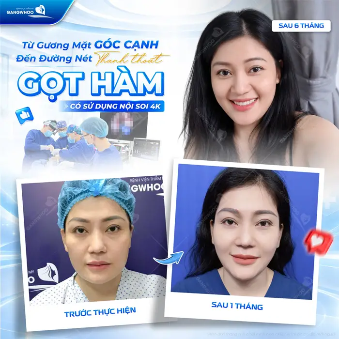 Bảng Giá Gọt Hàm Bao Nhiêu Tiền? Bảng Giá Mới Năm 2026 2 Từ gương mặt góc cạnh đến đường nét thanh thoát gọt hàm có sử dụng nội soi 4K kết quả sau 1 tháng hài hòa hơn thấy rõ