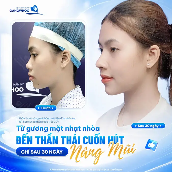 Từ gương mặt nhạt nhòa đến thần thái cuốn hút sau 30 ngày nâng mũi