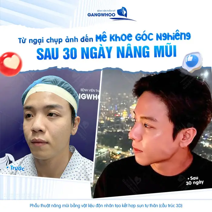 Sau 30 ngày annag mũi hoàn thiện nhan sắc tự tin khoe góc nghiêng bùng cháy
