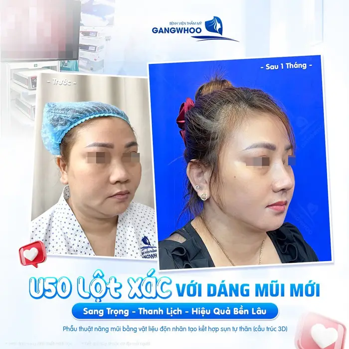 U50 lột xác với dáng mũi mới sang trọng, thanh lịch và hiệu quả duy trì bền lâu