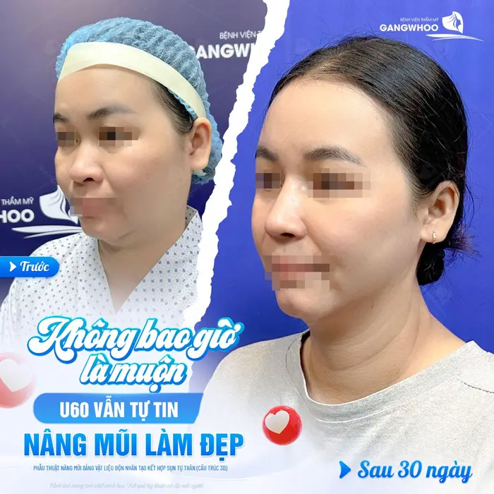 Không bao giờ là muộn khi U60 vẫn tự tin nâng mũi làm đẹp kết quả sau 30 ngày đã hòa toàn khác biệt