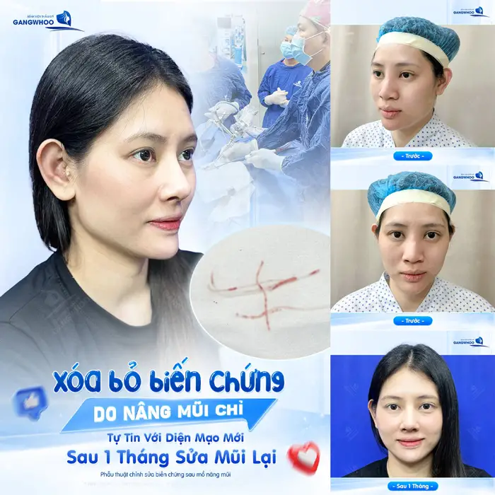 Xóa bỏ biến chứung do nâng mũi chỉ tự tin với diện mạo mới sau 1 tháng sửa lại 