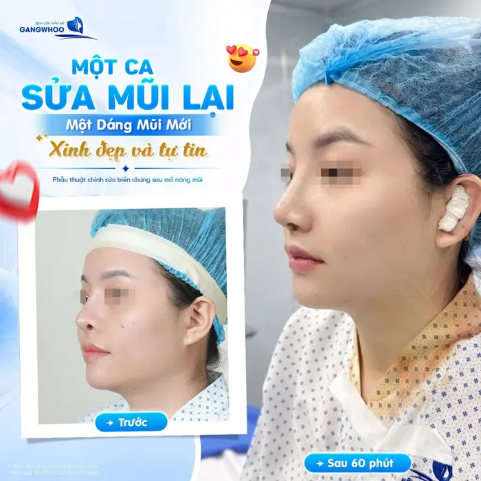 1 ca sửa mũi lại hoàn thiện 1 dáng mũi mới xinh đẹp và tự tin 