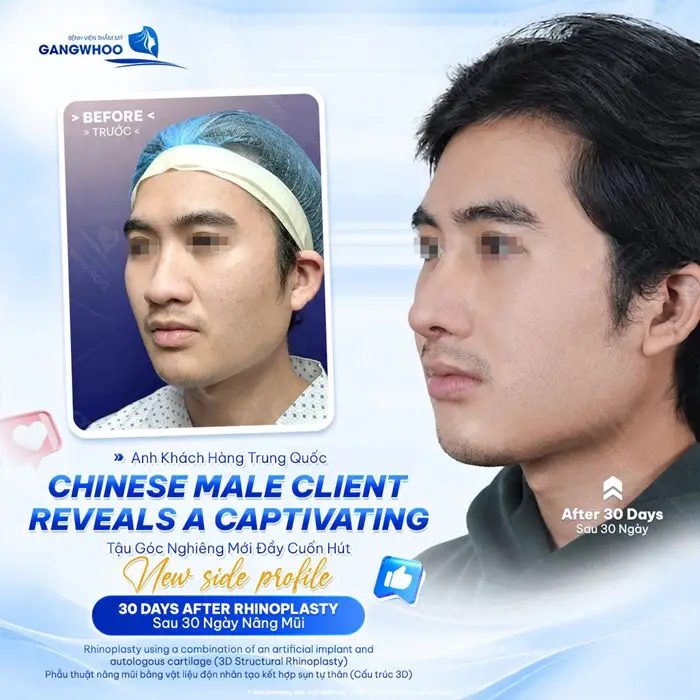 Tậu góc nghiêng mới đầy cuốn hút và bảnh trai với dáng mũi mới vừa hoàn thiện chỉ 30 ngày