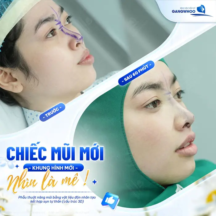 Chiếc mũi mới nhan sắc mới tôn đường nét cho gương mặt thêm rạng rỡ và đẹp chuẩn thần thái