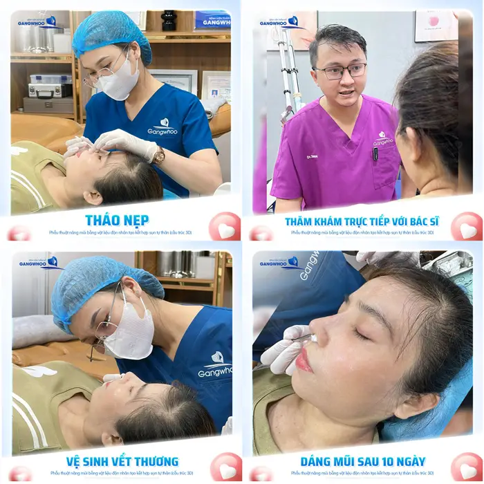 Nâng Mũi Mấy Ngày Tháo Băng, Tháo Nẹp Mũi? (Bác Sĩ Trả Lời) 4 Dáng mũi đẹp xuất sắc sau 10 ngày tháo nẹp đã thấy rõ góc nghiêng cao đẹp