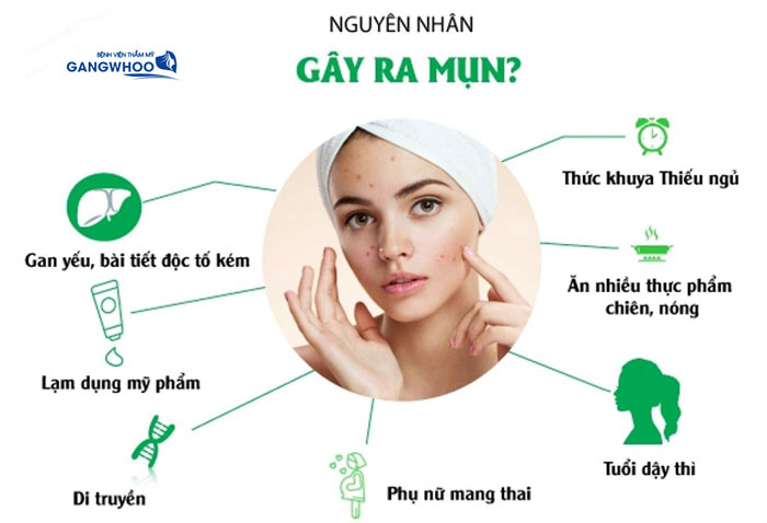 Tổng Hợp 19 Cách Điều Trị Mụn Bạn Cần Biết 17 Các nguyên nhân gây ra mụn