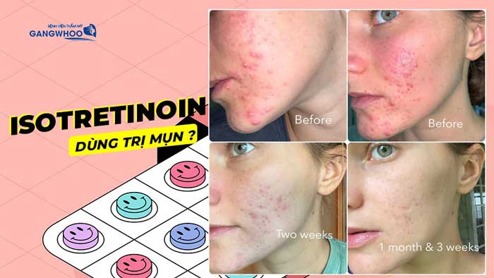 Isotretinoin acne therapy effectiveness