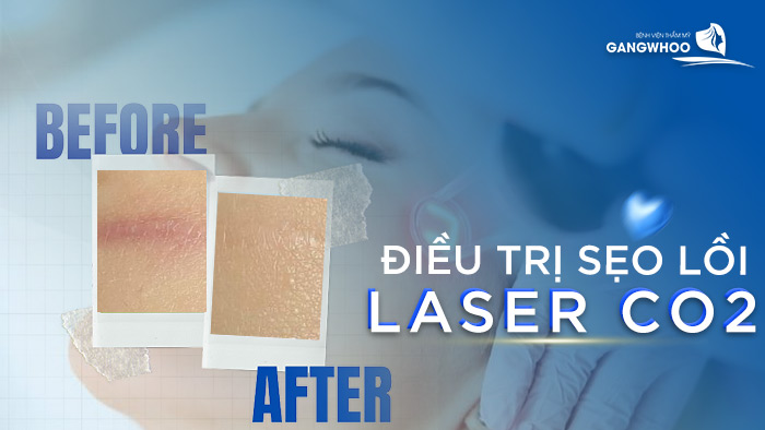 Điều Trị Sẹo Lồi Bằng Laser Co2 Là Gì? Có Hiệu Quả Không? 1 Điều Trị Sẹo Lồi Bằng Laser Co2