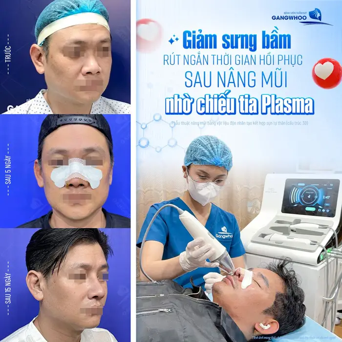 Giảm sưn gbầm rút ngắn thời gian hồi phục sau nâng mũi nhờ chiếu tia Plasma