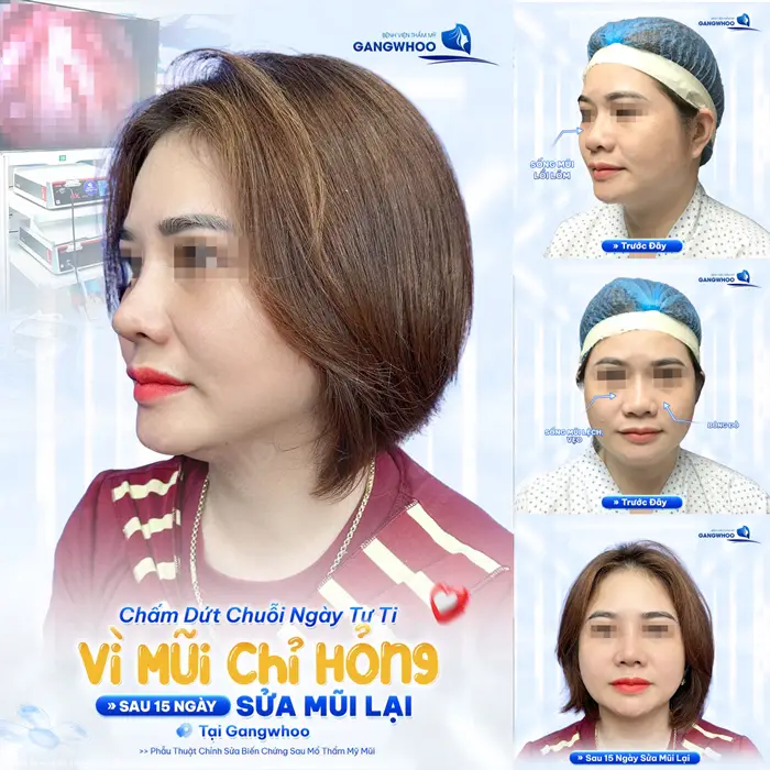 Chấm dứt chuỗi ngày tự ti vì mũi hỏng sau 15 ngày nâng mũi tại Gangwhoo gương mặt và diện mạo thêm điểm nhấn