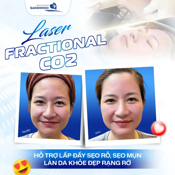 Điều Trị Sẹo Lồi Bằng Laser Co2 Là Gì? Có Hiệu Quả Không? 1 Laser Fractional CO2 hỗ trợ lấp đầy sẹo rỗ, sẹo mụn làn da khỏe đẹp đầy rạng rỡ