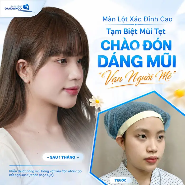 Màn lột xác đỉnh cao chào đón dáng mũi đẹp vạn người mê sau 1 tháng nhan sắc đã hoàn toàn thăng hạng