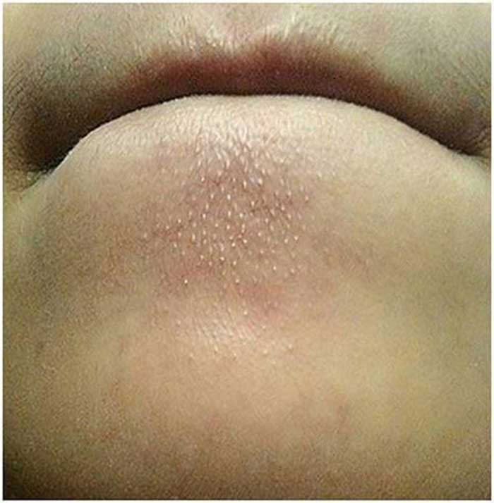 Chin blind pimples