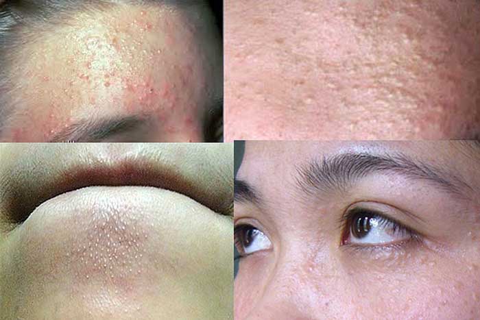 What are blind pimples?