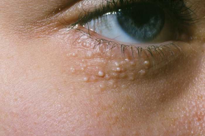 Milia acne around the eye