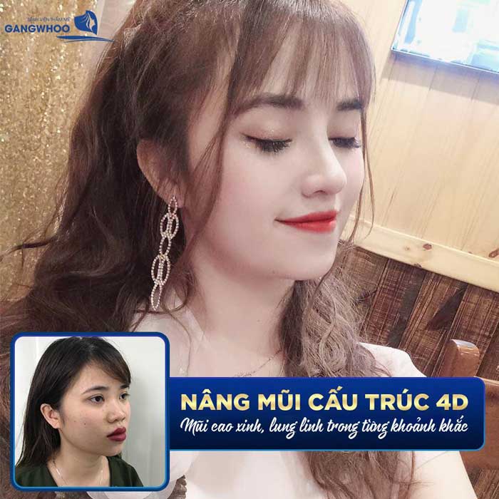 Không còn tự ti về mũi cũ sau khi sửa mũi 