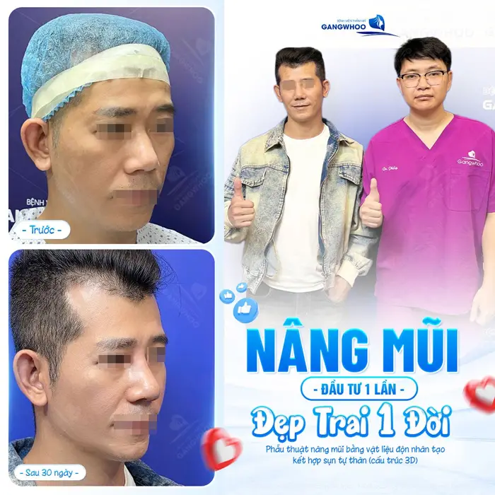 Nâng mũi đầu tư 1 lần đẹp trả cả đời chỉ sau 30 ngày từ nhan sắc đến diện mạo cũng khác biệt đến khó tin