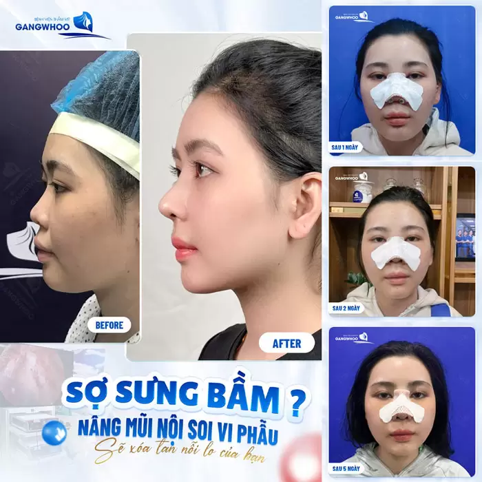 Nâng mũi nội soi vi phẫu không còn lo mũi bị sưng đau khó chịu