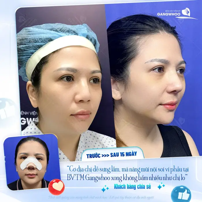 Sau 15 ngày nâng mũi không sưng bầm và nhanh hồi phục