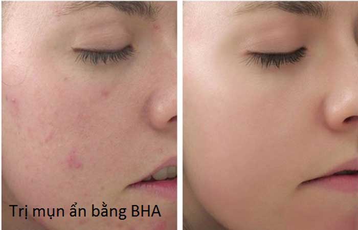 Result of blind pimples therapy with BHA