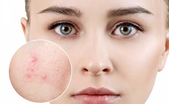 Popular acne treatment