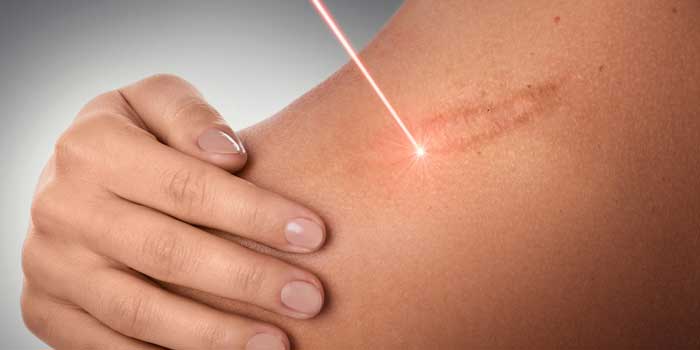 the cost of keloid scars treatment with laser
