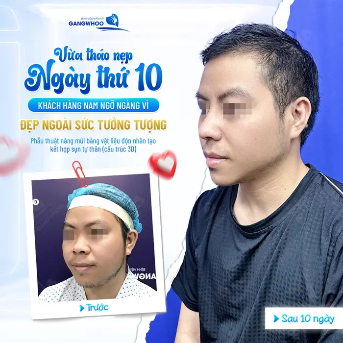 Nâng Mũi Mấy Ngày Tháo Băng, Tháo Nẹp Mũi? (Bác Sĩ Trả Lời) 1 Vừa tháo nẹp ngày thứ 10 khách hàng đã ngỡ ngàng vì kết quả đẹp vượt ngoài sức tưởng tượng