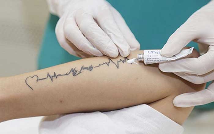 Skin caring after undergoing laser tattoo removal