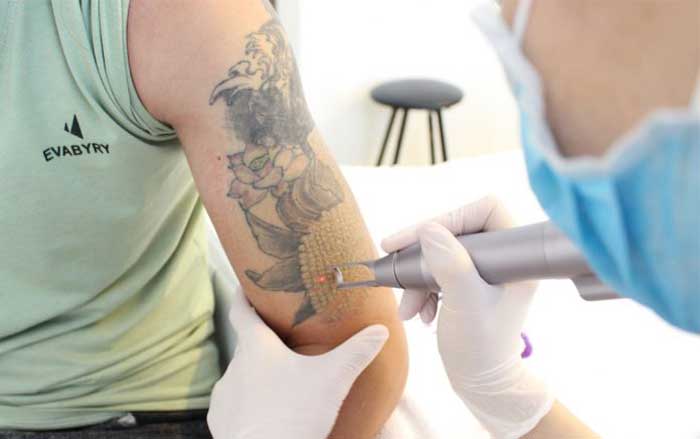 Laser tattoo removal